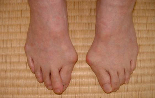 BOCHIKUN® Hallux Valgus Orthese Paar Edition