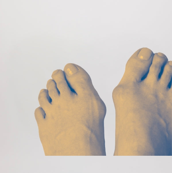 Hallux Valgus