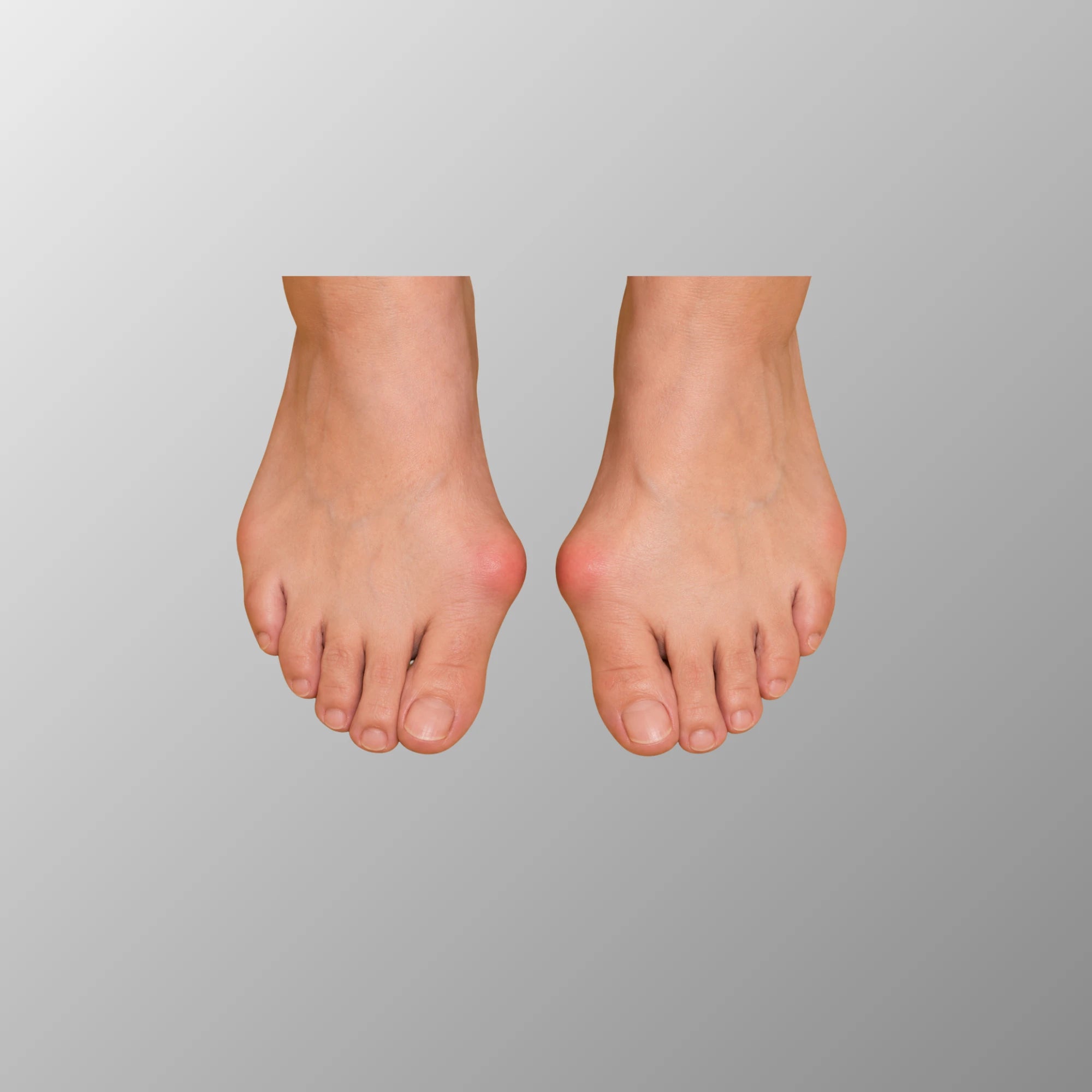 BOCHIKUN® Hallux Valgus Orthese Single Edition