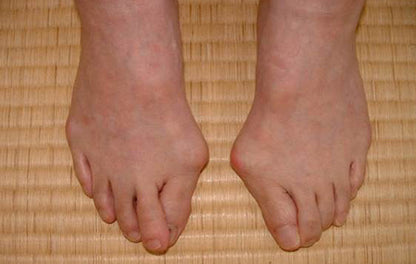 BOCHIKUN® Hallux Valgus Orthese Single Edition